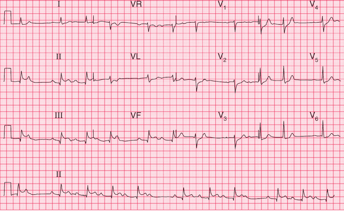 A 70-year-old man is admitted to hospital following the onset of severe central chest pain. This is his ECG. What does it show and what treatment is needed?