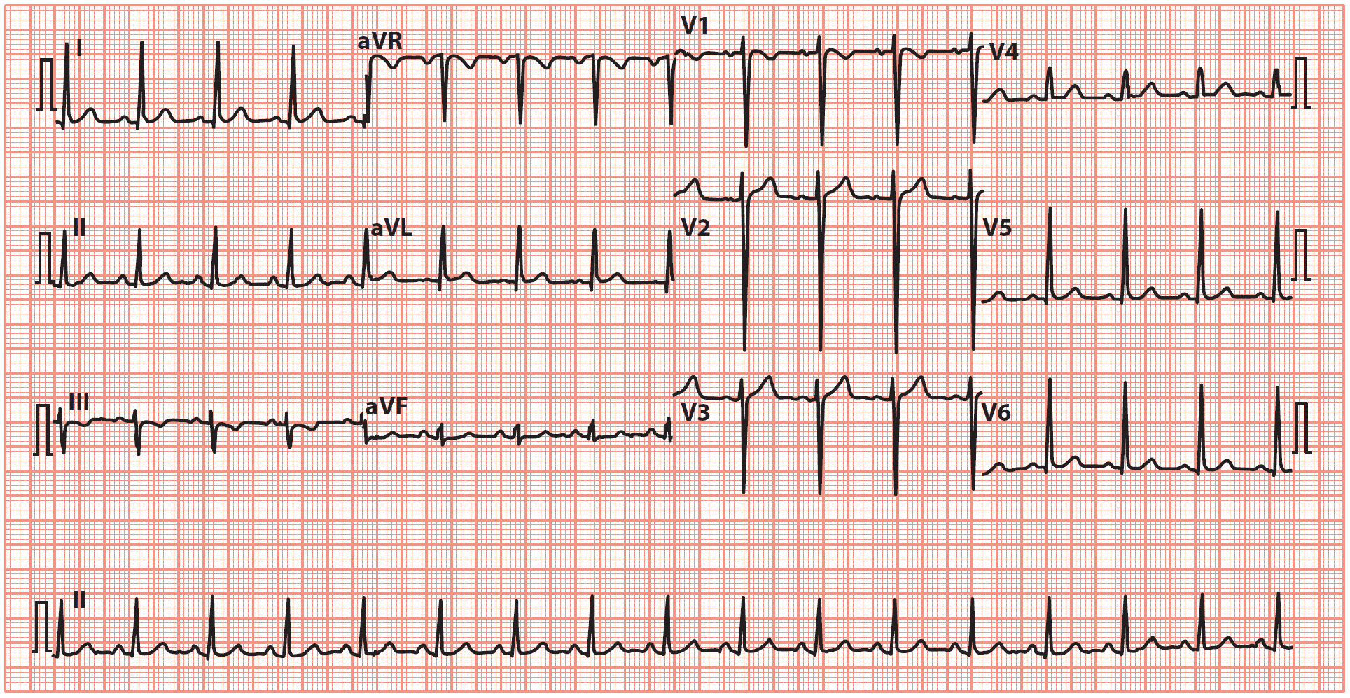 ECG of Left ventricular hypertrophy (LVH) with tall R waves in leads I, aVL, V5, V6, and deep S waves in leads V1, V2 and V3