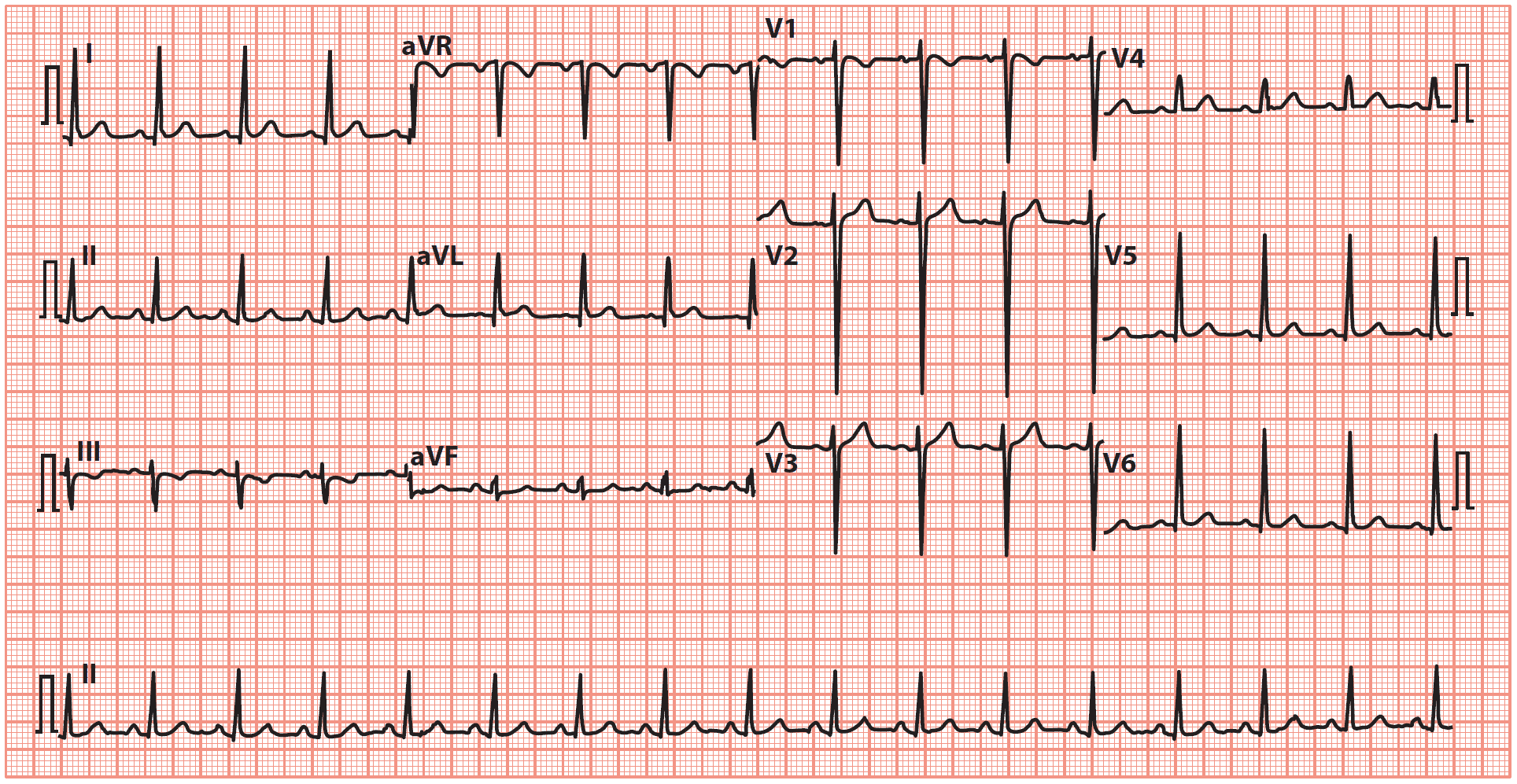 Left Ventricular Hypertrophy Lvh How To Recognize It On Ecg With