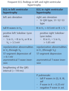 Left Ventricular Hypertrophy (LVH): How to Recognize it on ECG [With ...