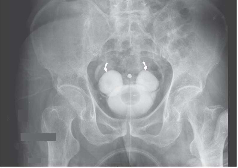 Intravenous urography shows symmetric bladder diverticula (Hutch diverticula)
