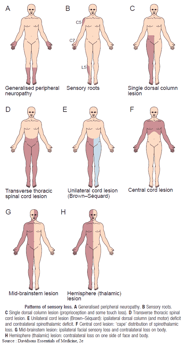 Patterns of Sensory Loss (Sensory Neurologic Deficit)