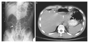 Read more about the article Telltale Triangle of Pneumoperitoneum Caused by Perforated Gastric Ulcer