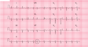 Read more about the article ECG Case 58: Anterior Wall MI with Spontaneous Reperfusion
