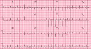 Read more about the article ECG Case 61: Atrial Flutter with 2:1 AV Conduction
