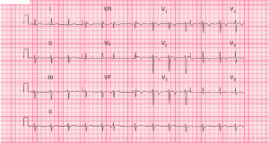 Read more about the article ECG Case 58