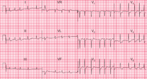 Read more about the article ECG Case 59: Atrial Fibrillation with Rapid Ventricular Response (RVR) and Diffuse Subendocardial Ischemia
