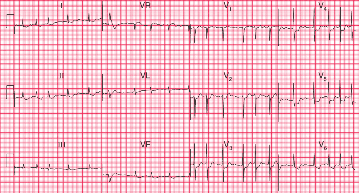 Atrial Fibrillation with Rapid Ventricular Response (RVR) and Diffuse ST Depression that indicates Subendocardial Ischemia