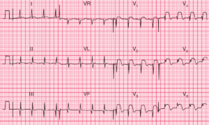 Read more about the article ECG Case 60: Acute Anterior MI and Old Inferior MI