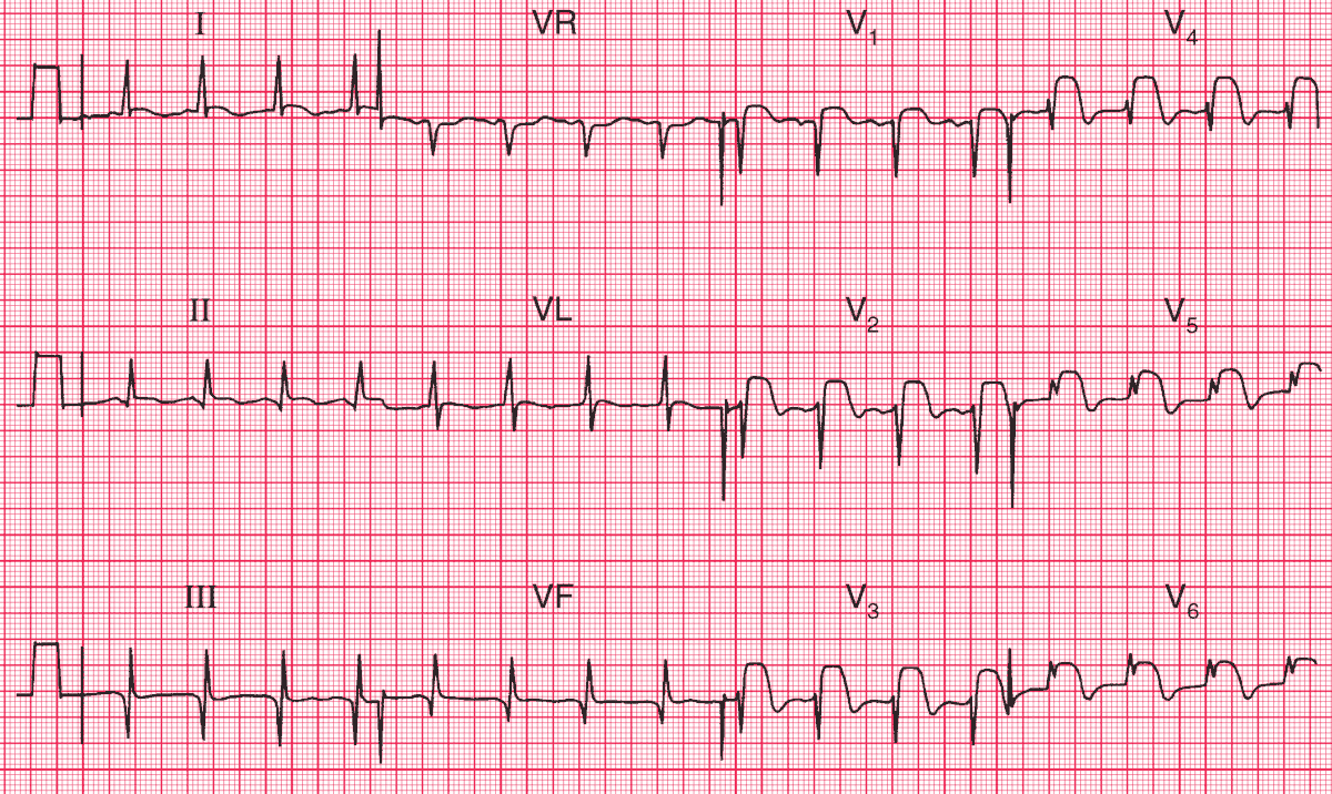 Acute Anterior MI (ST segment elevation (Tombstone morphology) in leads V1–V6) and Old Inferior MI (Q waves in leads II, III, VF)