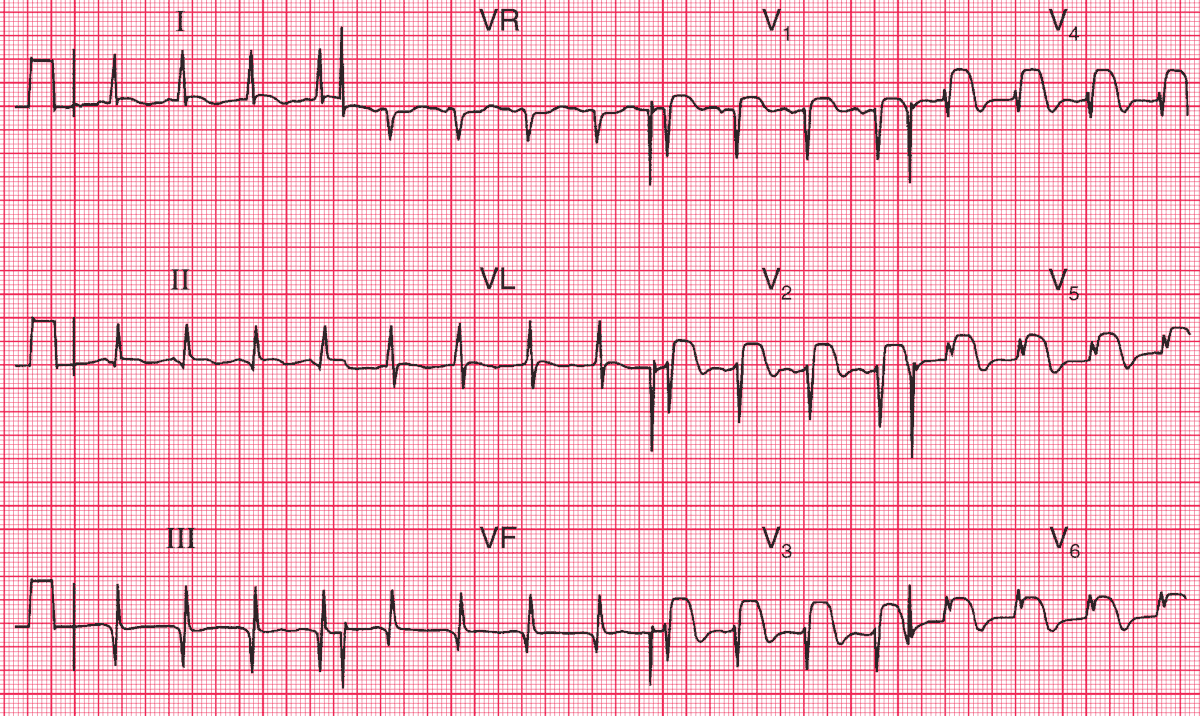 ECG Case 101: Lown-Ganong-Levine (LGL) syndrome - Manual of Medicine