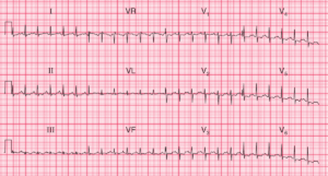 Read more about the article ECG Case 62: Pulmonary Embolism