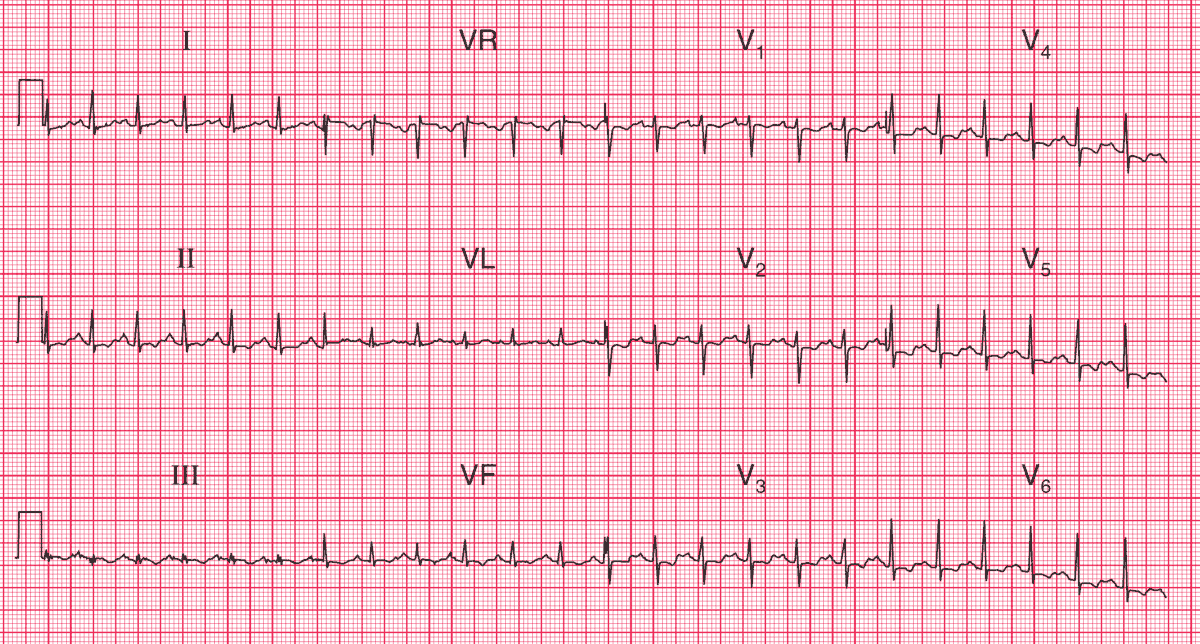 Sinus Tachycardia with ST segment depression in leads V1-V6 and T wave inversion in inferior leads (II, III, aVF) and all the chest leads (V1–V6) suggesting pulmonary embolism