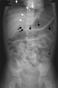 Read more about the article Pneumoperitoneum from Cecal Perforation due to Enteritis