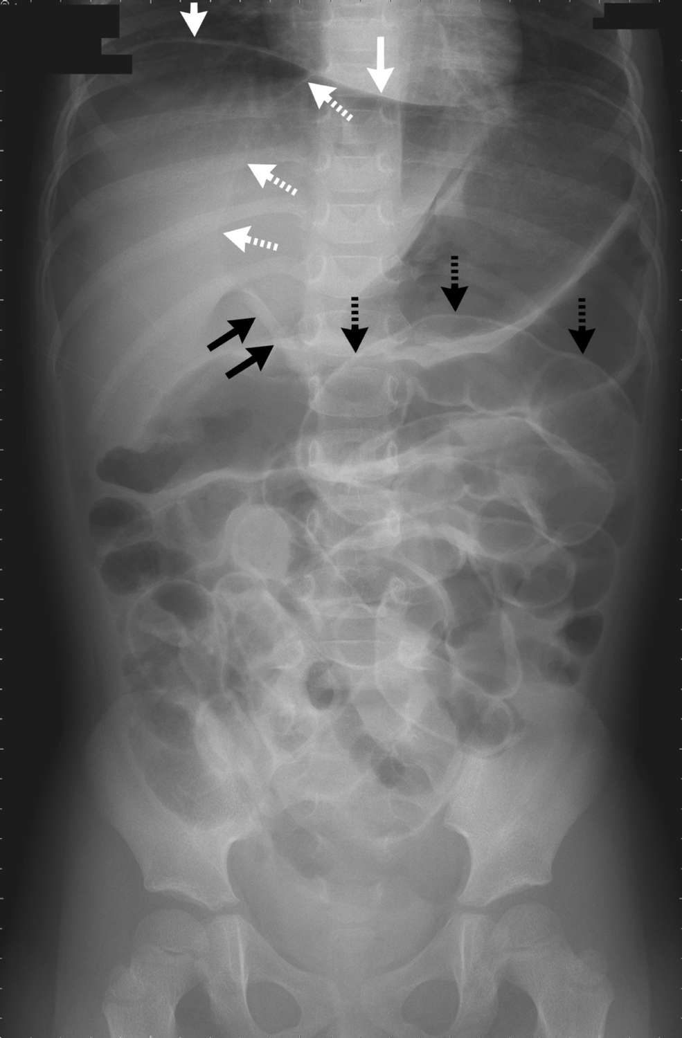 Signs of Pneumoperitoneum on Abdominal X-Ray