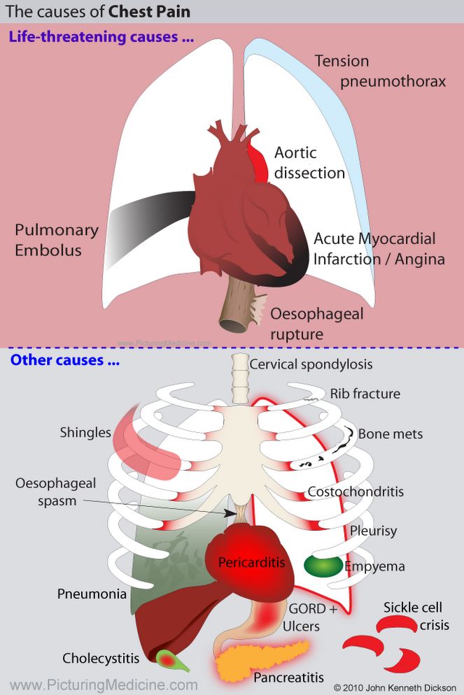 The Causes of Chest Pain