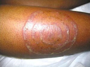 Read more about the article Violaceous Plaque Consisting of Four Concentric Rings on Leg