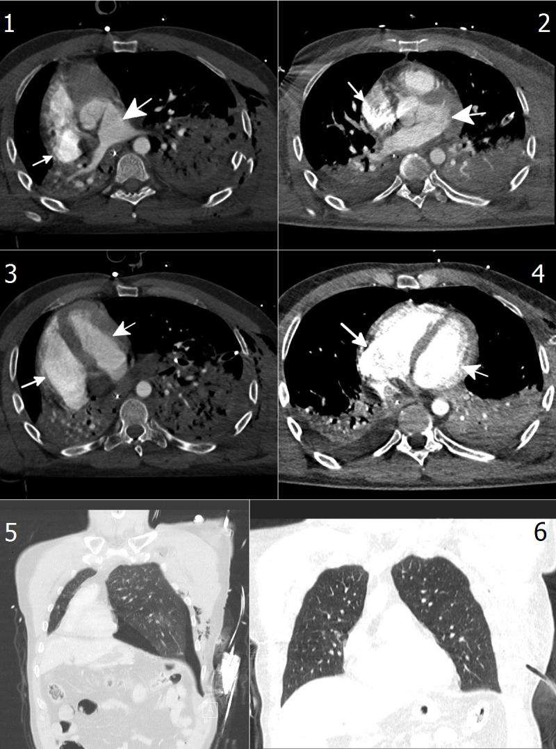 Chest CT showing left tension pneumothorax and multiple rib fractures, bilateral pulmonary contusion, and ruptured spleen