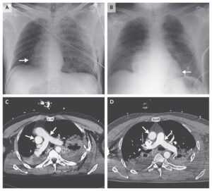 Read more about the article Traumatic Tension Pneumothorax Causing Heart Rotation