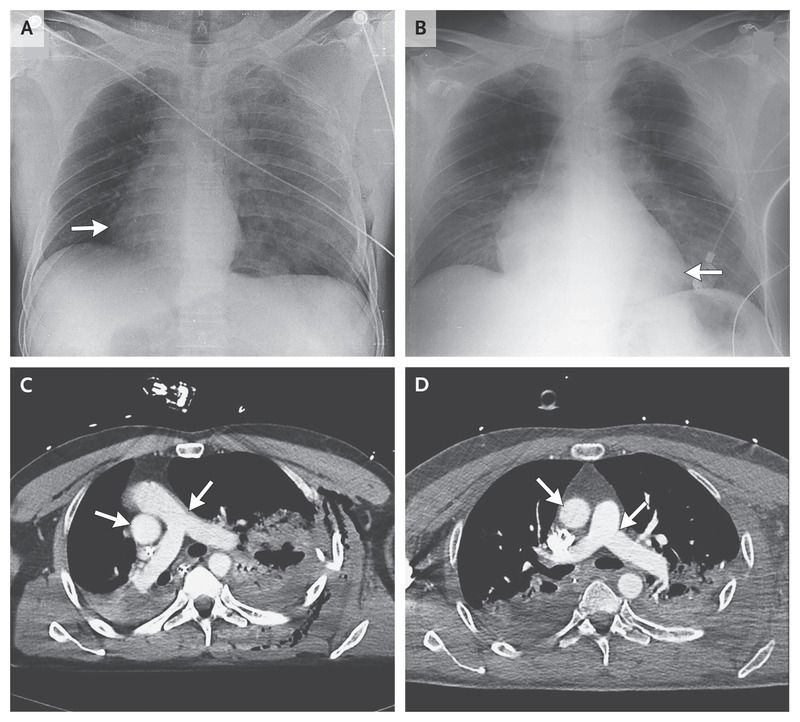 A chest radiograph and computed tomographic (CT) scan showed a 90-degree rightward rotation of the cardiac silhouette and great vessels