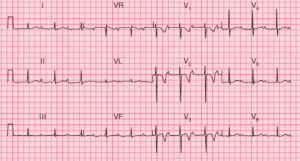Read more about the article ECG Case 63: Wellens Syndrome (Critical stenosis of the left anterior descending artery (LAD))