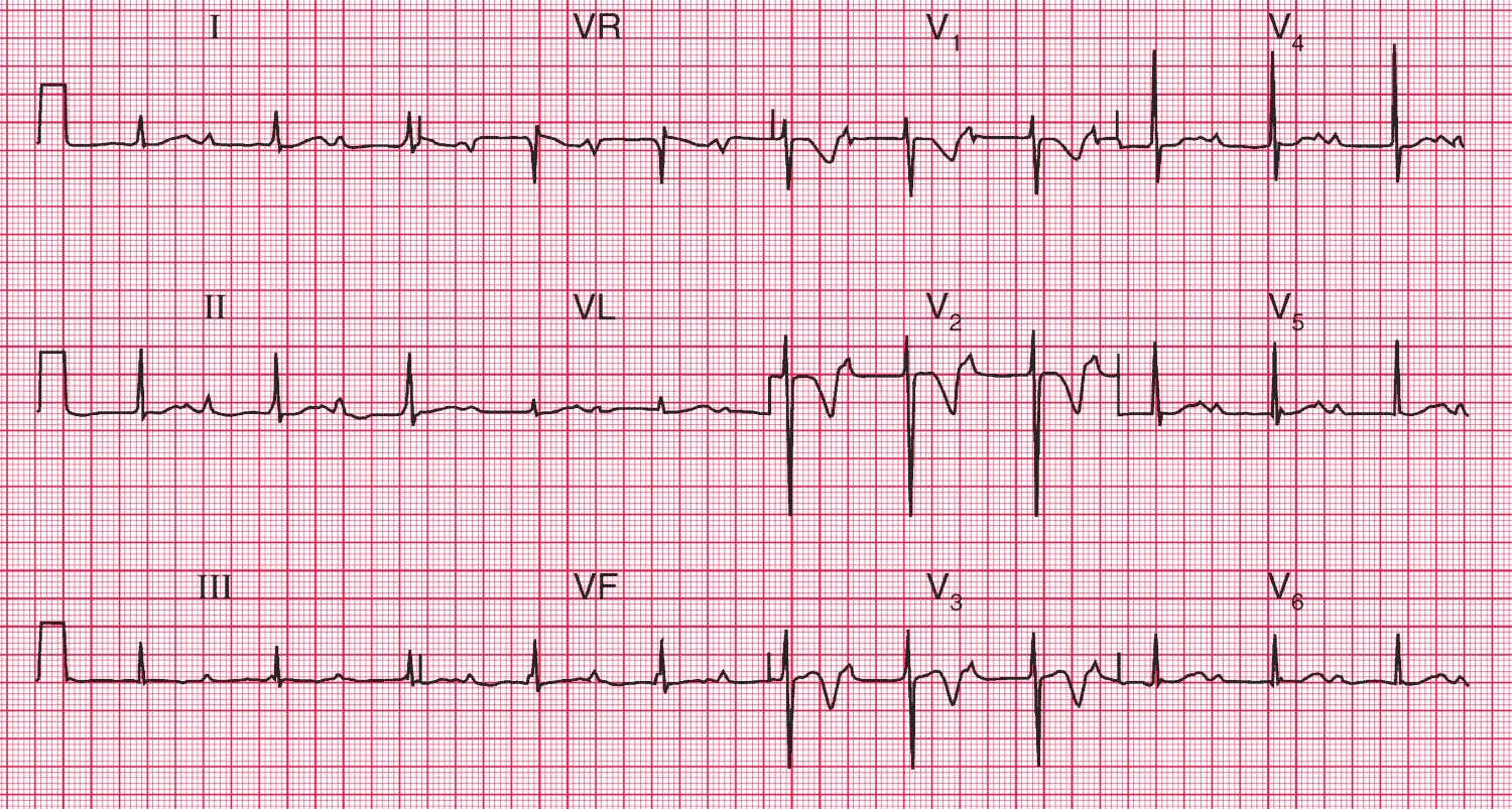 Deeply inverted T waves in leads V1, V2 and biphasic (up-down) T wave in lead V3 indicating Wellens Syndrome (Critical stenosis of the left anterior descending artery (LAD))