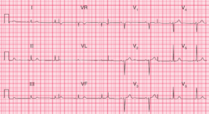 Read more about the article ECG Case 64: Old Anterior Myocardial Infarction