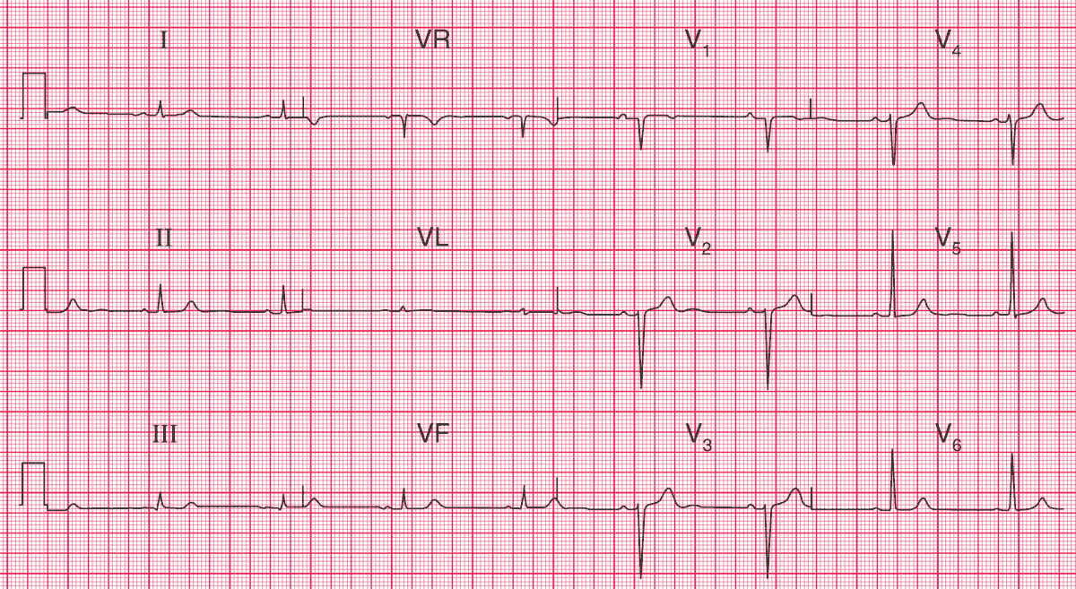 Read more about the article ECG Case 64