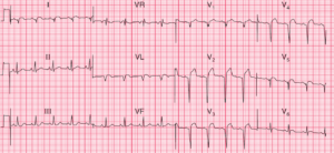 Read more about the article ECG Case 65: Old Anterolateral MI with Left Ventricular Aneurysm