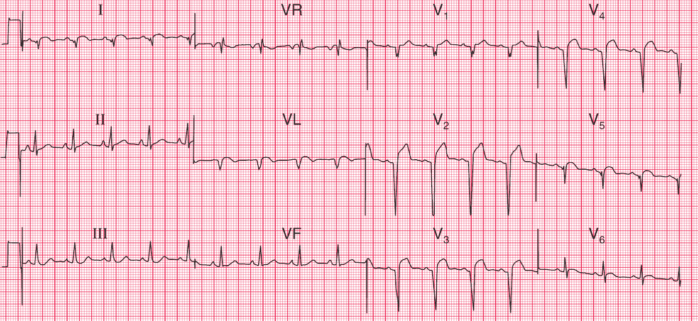 Old Anterolateral MI with Left Ventricular Aneurysm with with well-formed Q or QS waves in precordial leads