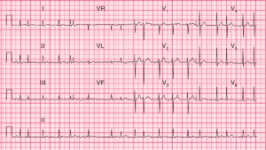 Read more about the article ECG Case 66: Atrial Fibrillation with an Uncontrolled Ventricular Rate