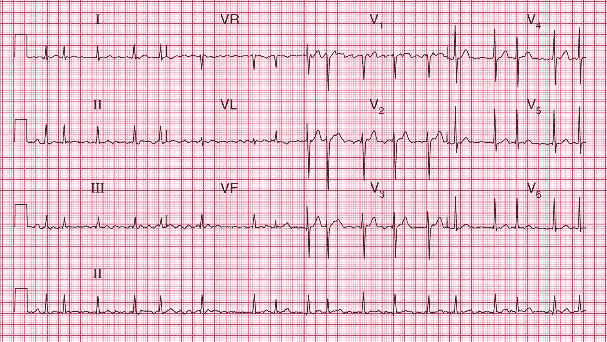 Atrial Fibrillation with an Uncontrolled Ventricular Rate