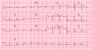 Read more about the article ECG Case 67: Ectopic atrial rhythm