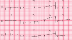 Read more about the article ECG Case 68: Dextrocardia