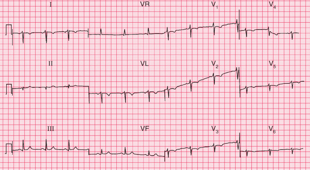Read more about the article ECG Case 68