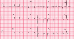 Read more about the article ECG Case 69: Atrial Fibrillation and Digoxin Effect