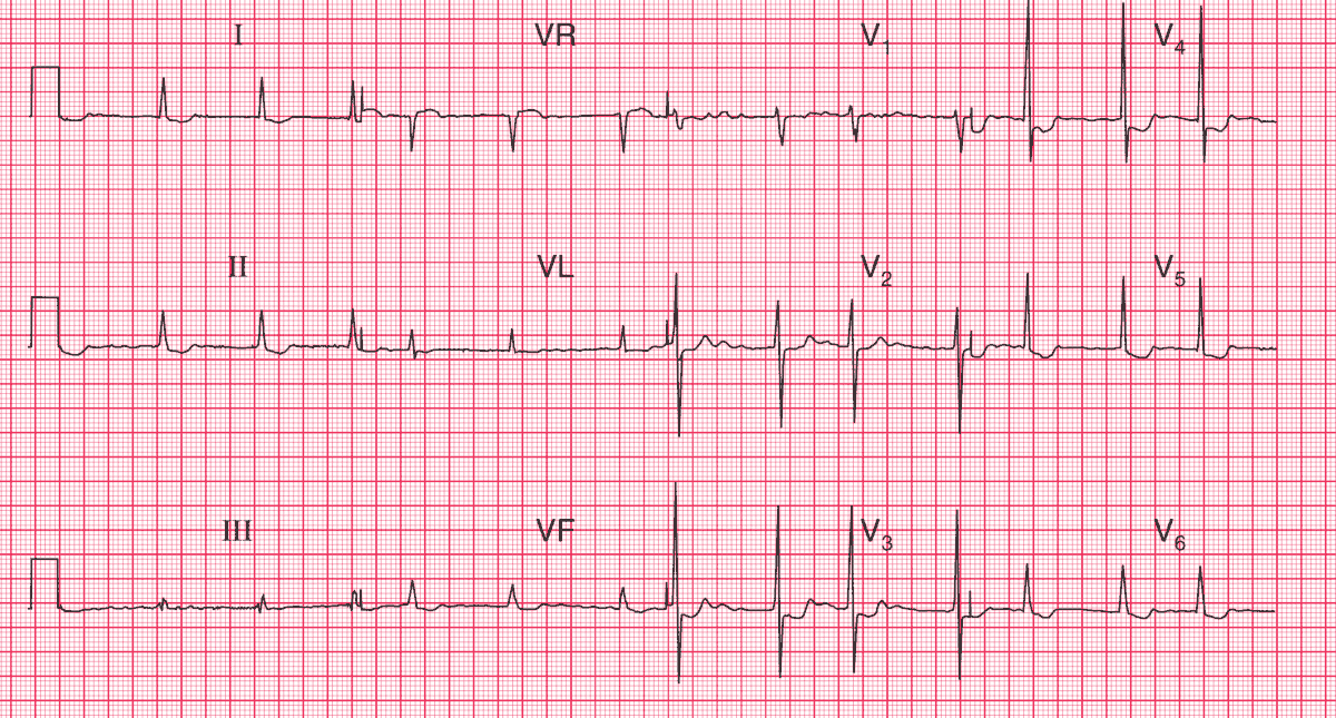 Atrial Fibrillation and Digoxin Effect ( Downward-sloping ST segment depression in leads V4–V6, I, II and aVF and Biphasic T waves (down-up) )