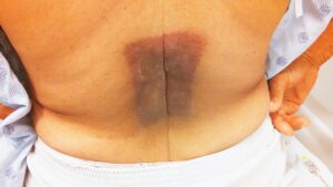Read more about the article Hyperpigmented Square on Lower Back