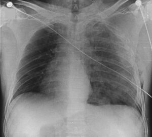 Read more about the article Patient with Chest Trauma Related to a Motorcycle Accident