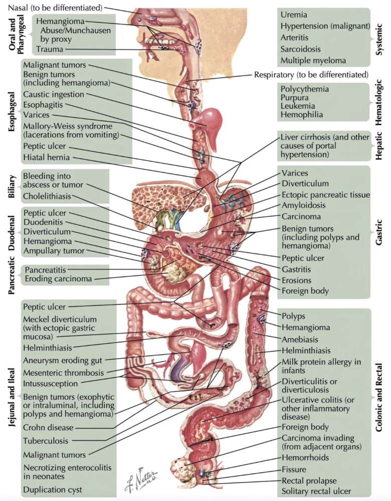 Causes of Gastrointestinal Bleeding
