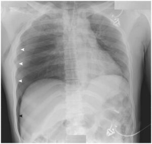 Read more about the article Deep Sulcus Sign (Pneumothorax)