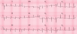 Read more about the article ECG Case 70