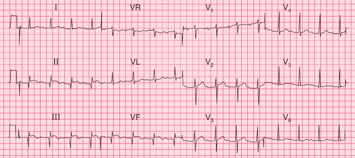 Acute inferior myocardial infarction with first degree block, due to dissection of the aorta