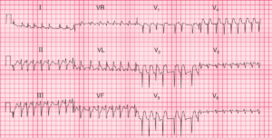 Read more about the article ECG Case 71: Atrial fibrillation with RVR, LAFB and Acute Anterolateral STEMI