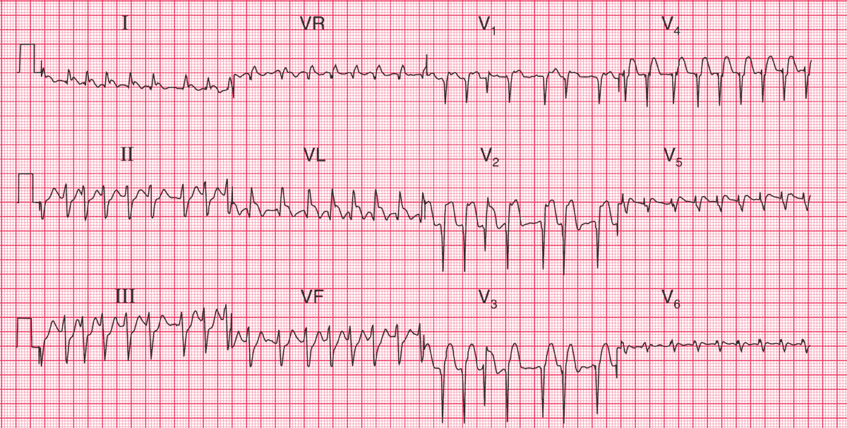Atrial fibrillation with RVR, LAFB and Acute Anterolateral STEMI