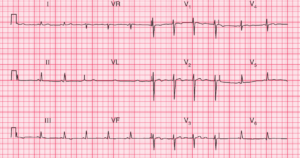 Read more about the article Nonspecific ST segment and T wave changes