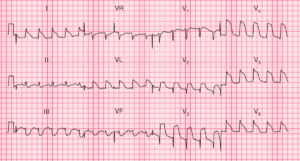 Read more about the article ECG Case 73: Acute Anterolateral STEMI with Tombstone ST Elevation