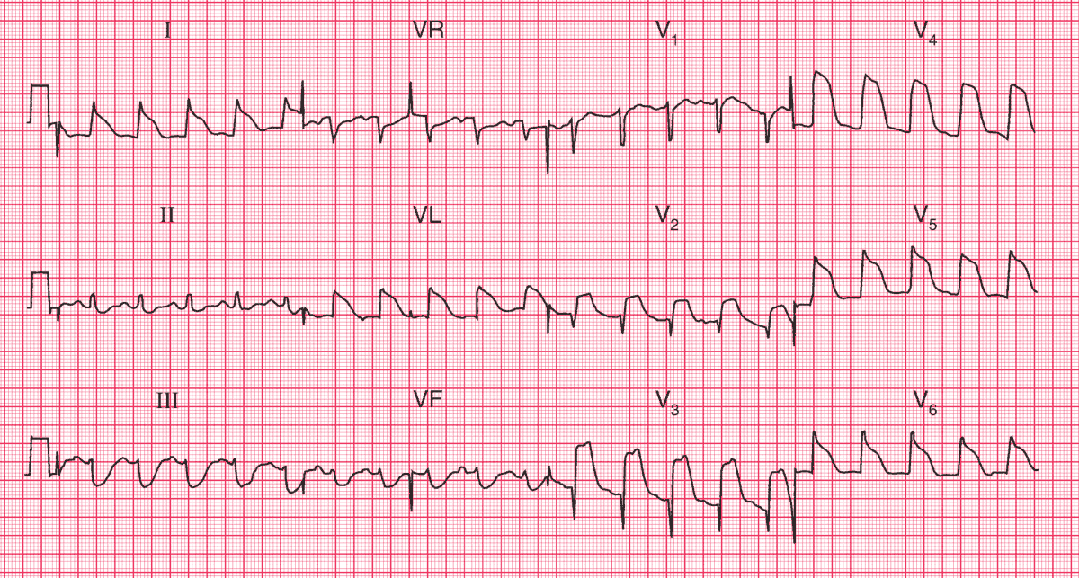 Acute Anterolateral STEMI with Tombstone ST Segment Elevation