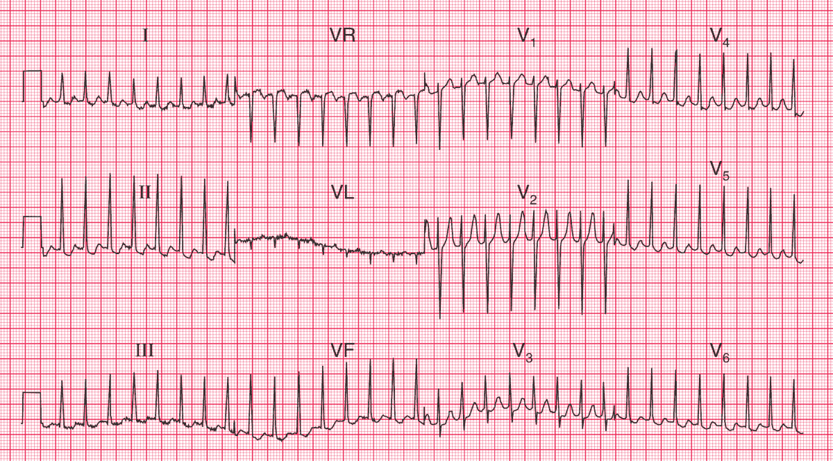 AV nodal re-entry tachycardia (AVNRT)