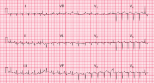 Read more about the article ECG Case 75: Sinus Tachycardia with Right Atrial and Right Ventricular Hypertrophy – Suggesting Chronic Lung Disease
